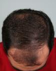 Before Hair Transplant&nbsp;Front